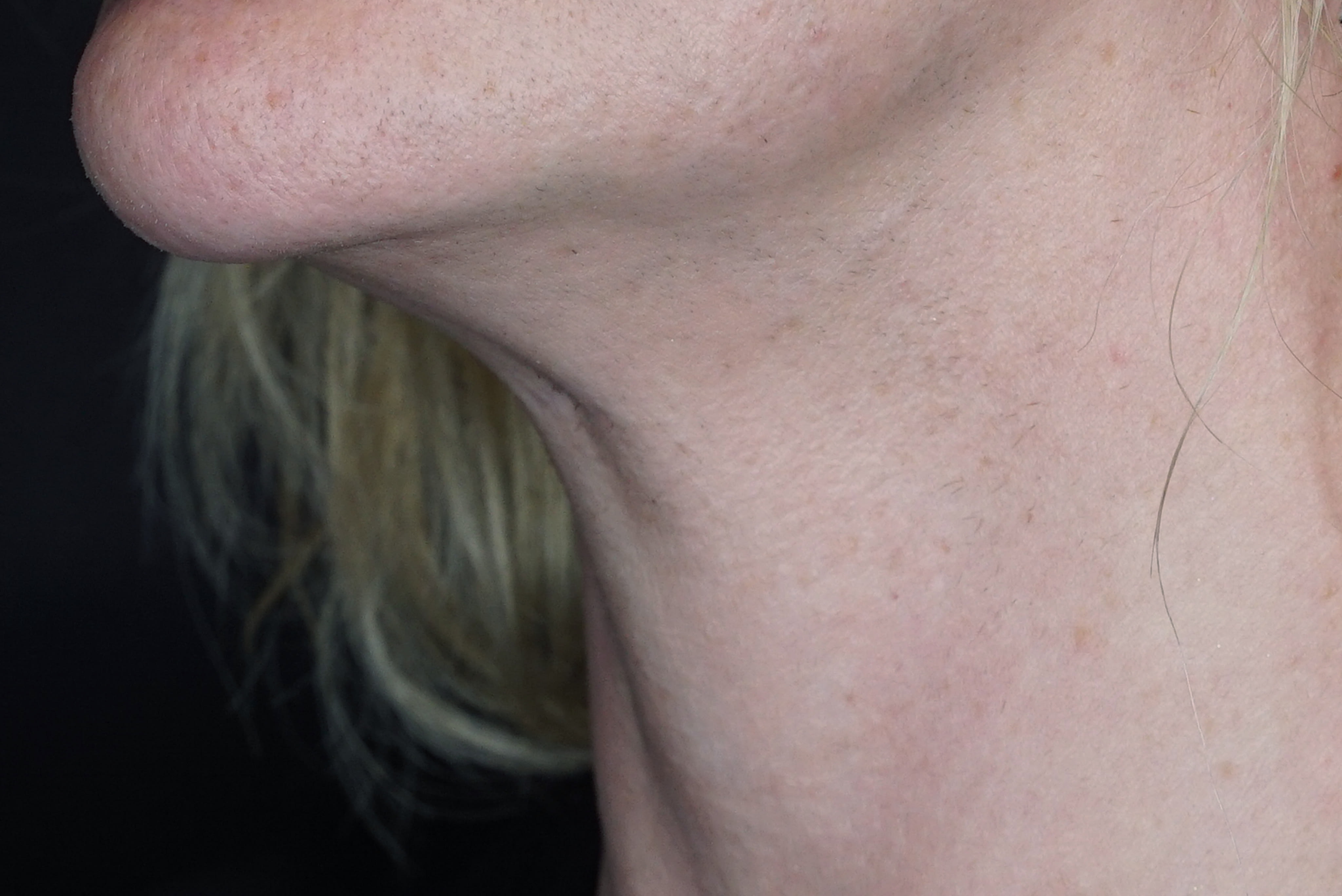 Laser hair removal chin after one session